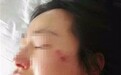 女医生称因“不会宰人”被领导打 涉事医院为莆田系