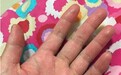 手指皲裂湿疹怎么办？找到具体的诱发原因很重要