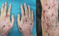 「蝴蝶宝贝」病例分享，人类罕见病中最痛苦的疾病之一