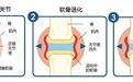 保养关节该怎么做？来看看氨糖软骨素钙片的功效和作用