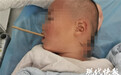 心疼！一根筷子把2岁多孩子的脖子戳穿了