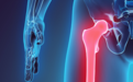 股骨头坏死怎么办？保头还是置换？