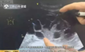无知！为买新款苹果手机，20岁女孩地下诊所卖卵，报酬仅1万