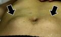 15 岁糖尿病患儿注射大剂量胰岛素自杀，如何急救？