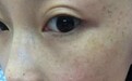 脸上长斑怎么办？怎么调理？亲身祛斑经验分享（疯转）
