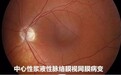 经常熬夜过度疲劳工作紧张，小心中浆恋上中青年男性