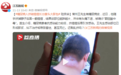 糖尿病人挤破痘痘长出拳头大脓包 险丧命