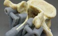 神奇的3D打印椎板 可改变复杂外科手术