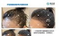 嘉美信--发际线稀疏用微芮希生发真的有效吗？