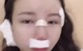 千万网红的10年整了5次鼻子，这些坑踩得太惨了！