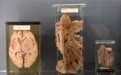 维也纳博物馆重新展出5万个人体部位器官，引发道德争议