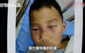长沙5岁男孩挖鼻孔导致脸肿似奥特曼！医生紧急提醒…