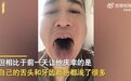 热搜！男子确诊后舌头牙齿全变黑！阳性期间身上痒？专家警告：千万别不当回事……