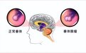 头痛，视力下降？内分泌赵一鸣博士提醒您警惕垂体瘤！
