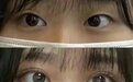 石家庄哪里割双眼皮好？双眼皮修复医生推荐？苏亚美联臣双眼皮价格一览表