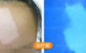 南通复大治疗白癜风怎么样看看刘女士的治疗经历就知道了