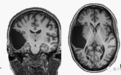 她缺失一部分大脑却能正常生活 完成研究生学业还精通两种语言