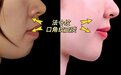 牙齿正畸与面部年轻化，到底有哪些关系？