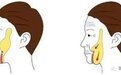 郭鑫医生：口角囊袋/羊角腮可通过面部吸脂改善