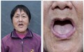 中家医家庭医生口腔种牙无上限，90也能做种植牙