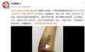 女生抽血后手臂瘀青发黑：胳膊无法伸直，大臂发痛很影响生活