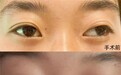 天真无“斜”儿童眼病救助项目 第二批16名斜视儿童已完成手术