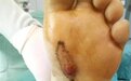 我把患者脚底「挖空」才找到了漏诊两年的病因