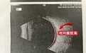 20岁，视网膜脱离！合肥普瑞眼科眼底病专家提醒：这件事要特别注意……