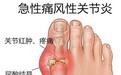 盘点痛风的危害，哲成生物教你如何正确降低痛风带来的痛苦