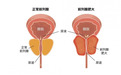 前列腺增生苦不堪言？前列康治养兼备更专业