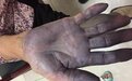 80 岁女性手脚淤紫，怀疑「被鬼打了」，病因扑朔迷离
