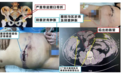 下半身被 2 吨钢板砸中坏死，「半身截除」1 年后，患者怎么样了？