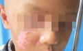 南通复大白癜风医院看病贵吗？在线分享孩子白斑复色经历