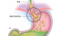 西安莲湖秦华中医医院专家郭小平：什么是胆汁反流性胃炎？应注意什么？