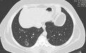 少见的新冠感染后肺部 CT 征象，你能解读吗？