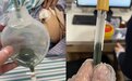 教训！引流管流出墨绿色液体，冲管后患者却…