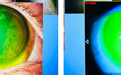 中国眼谷超级眼视光医院完成浙江省首枚巩膜镜的正式验配