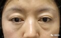 郭鑫医生案例分享：外切去眼袋＋眶隔脂肪填泪沟
