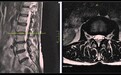 现代人腰椎问题的全面解决方案：Discseel®Procedure・DST椎间盘修复再生术