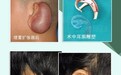 八大处整形赵延勇为您详解皮肤扩张法耳廓再造