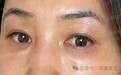 郭鑫医生：泪沟脂肪填充过量怎么办