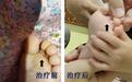 1岁宝宝脚趾深度糜烂，竟因大人传染足癣！家长需警惕