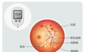 【合肥爱尔】糖尿病还会引发致盲眼病？及时防治很重要