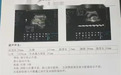 米非司酮 + 米索流产，胎头娩出后，剩下的胎儿竟然消失了