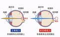 成都爱尔巫雷院长提醒白内障与老花眼如何区分
