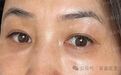 郭鑫医生：泪沟脂肪填充修复整形 专业实力 匠心塑美