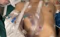 咸宁小伙不幸被机器绞断右臂，医生奋战6小时妙手接回