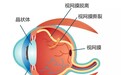 成都爱尔胡建斌院长提醒视网膜脱离到底有多危险？