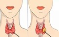 甲状腺结节会自己消失吗？米诺娃甲状腺外科朱精强教授说…