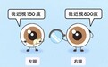 双眼视力差距大怎么矫正？“双术式联合”精准拯救屈光参差